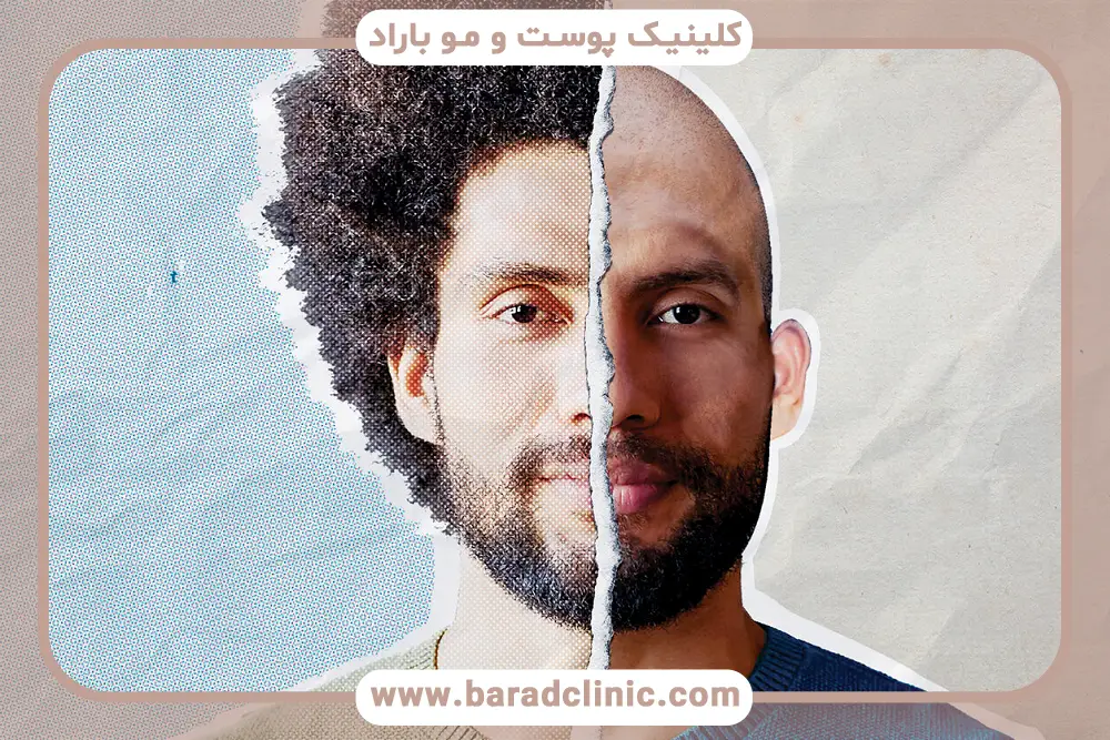 درمان ریزش ریش با مدیریت استرس