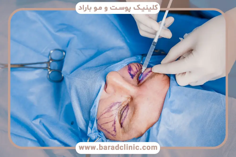 مراقبت‌های بعد از بلفاروپلاستی پلک بالا و پایین به صورت همزمان 