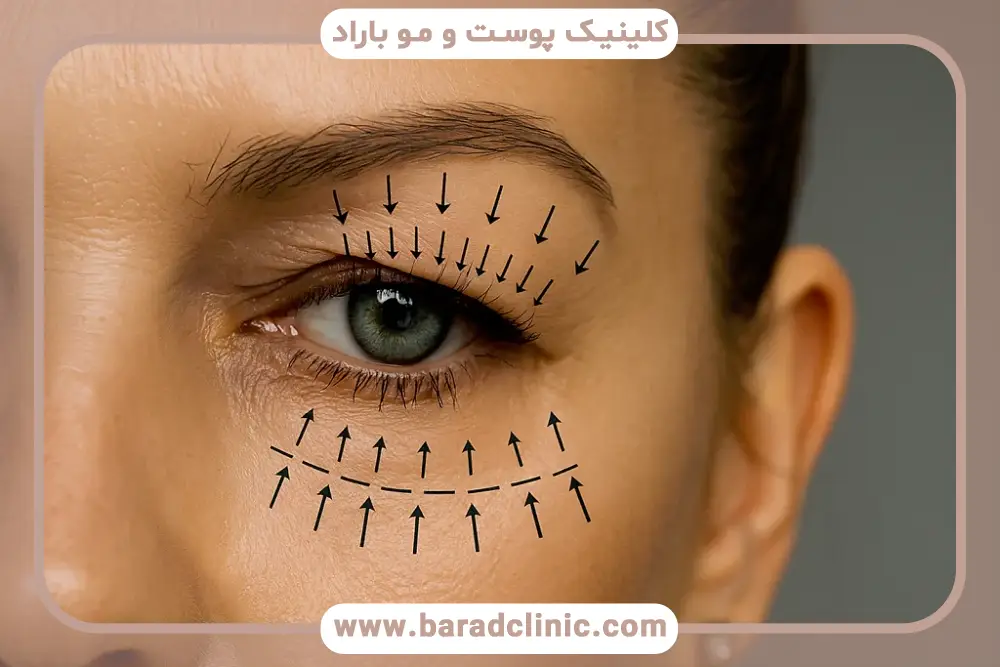 ایا عمل پلک برگشت دارد؟