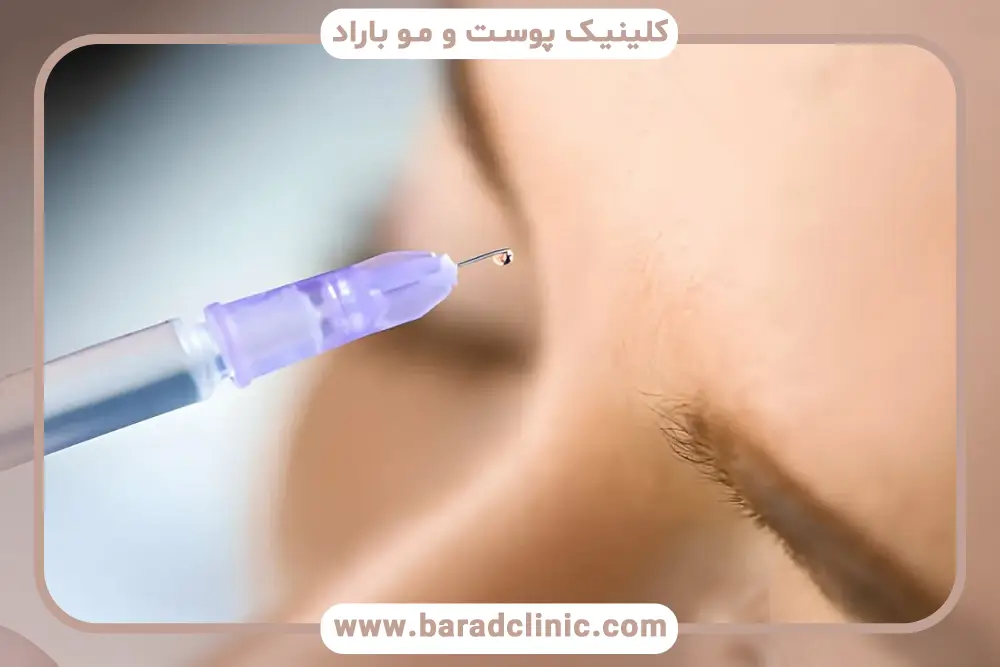 مقایسه مزوتراپی و prp از نظر عوارض جانبی