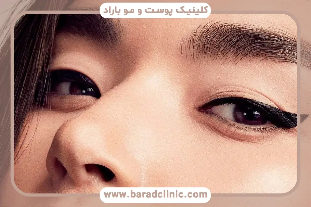 خشکی چشم و نیاز به ترمیم عمل بلفاروپلاستی 