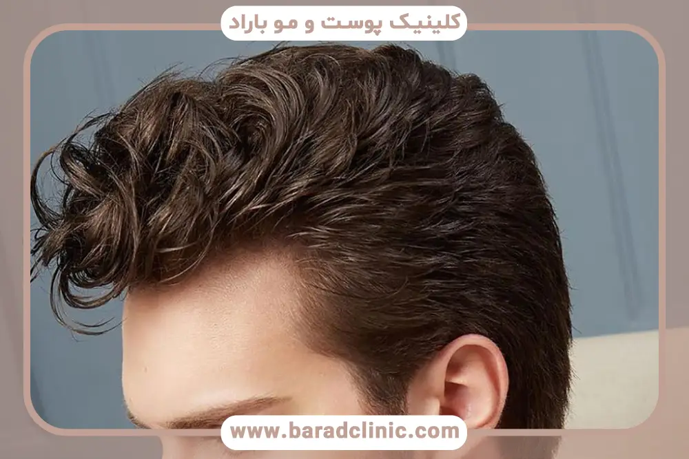 کاشت مو برای درمان سریع ریزش مو 