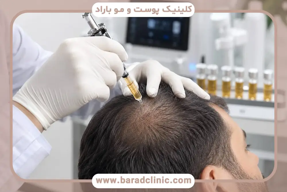 مزوتراپی جلوی سر بعد از کاشت مو