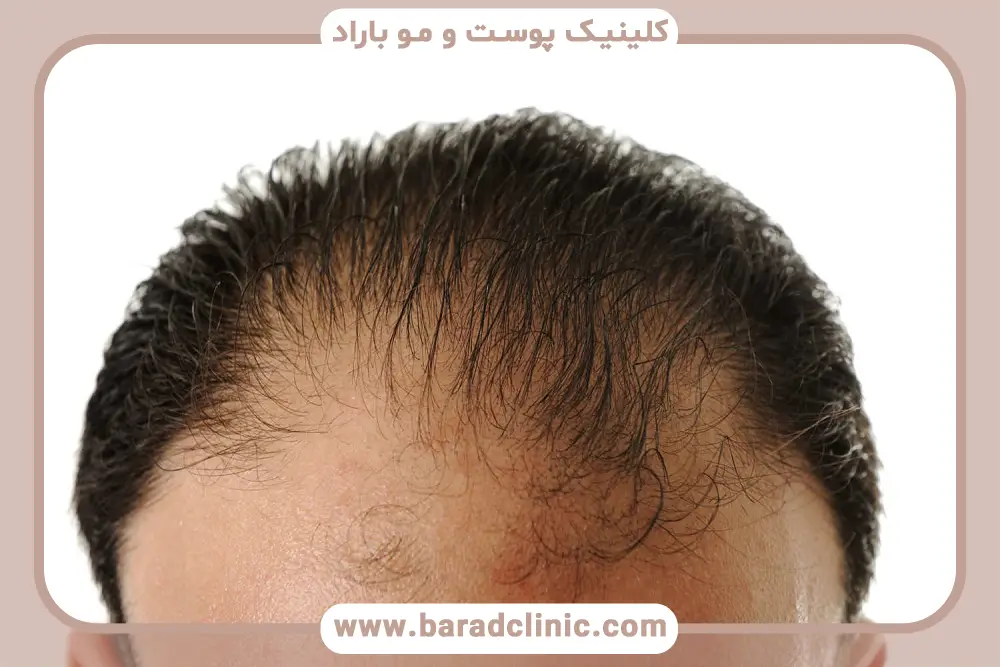 کدام ریزش مو خطرناک است؟ روش تشخیص
