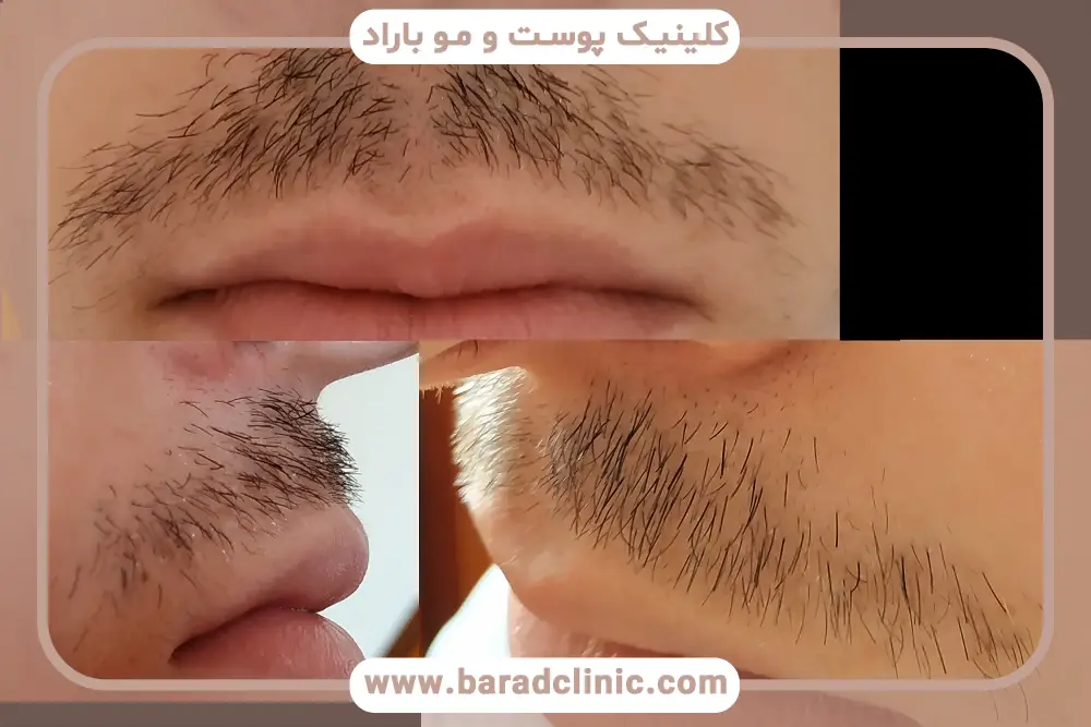 تاثیر سبک زندگی روی سن رشد سبیل 