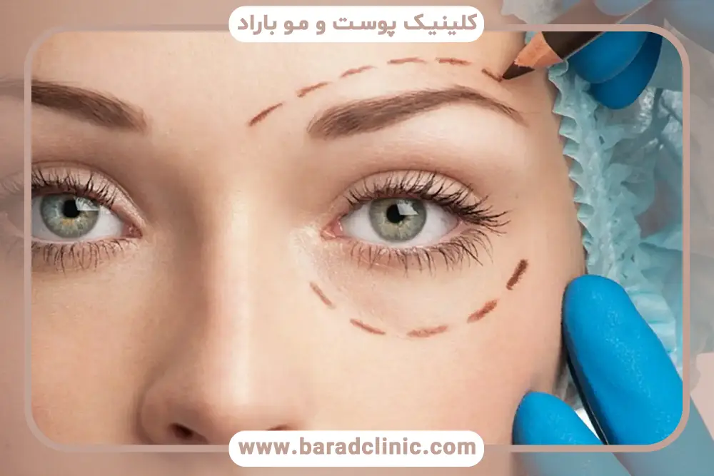نحوه استفاده از عینک بعد از بلفاروپلاستی