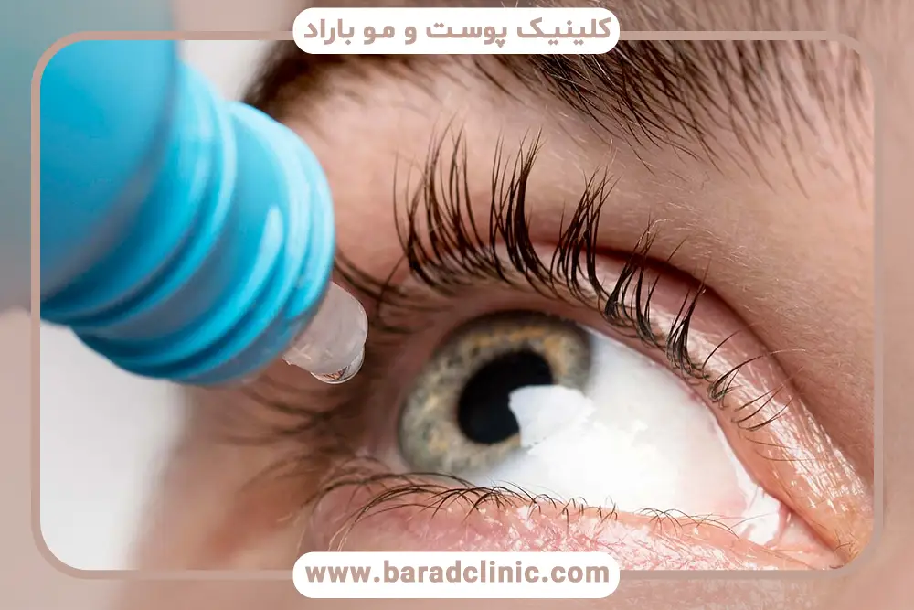 اشتباهات رایج در شستشوی چشم بعد از عمل بلفاروپلاستی