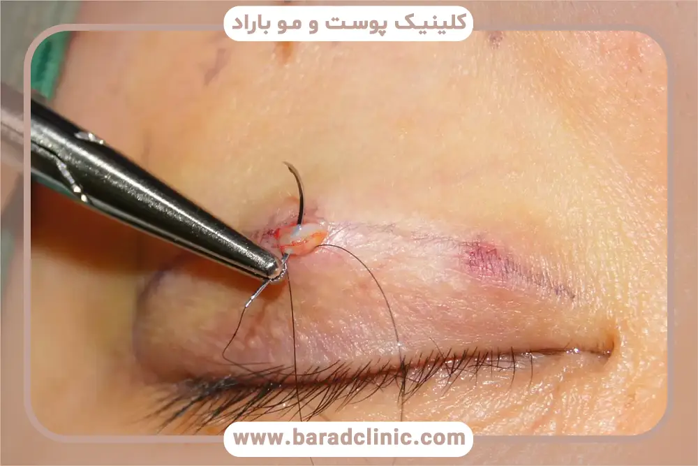 تاری دید از علائم عفونت چشم بعد از عمل بلفاروپلاستی