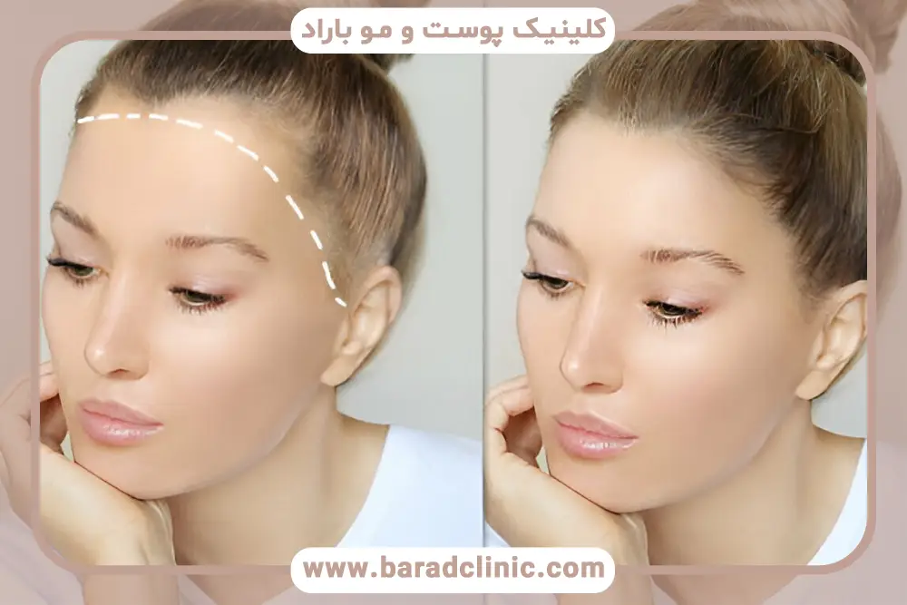 کاشت مو برای زنان چگونه است؟ بررسی روشها