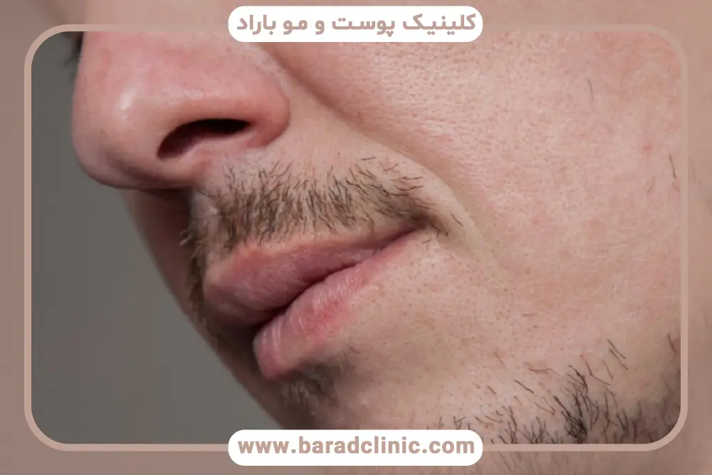 علائم پایین بودن DHT