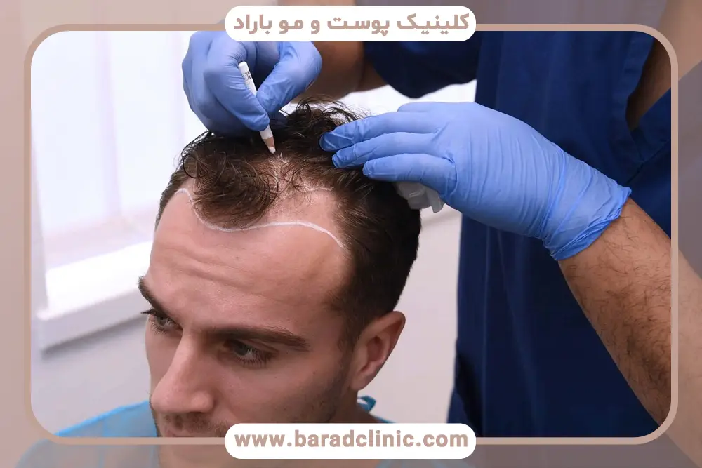 تجهیزات آخرین روش کاشت مو