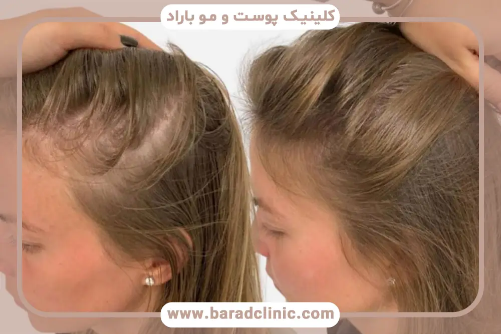 هزینههای جانبی کاشت مو برای زنان