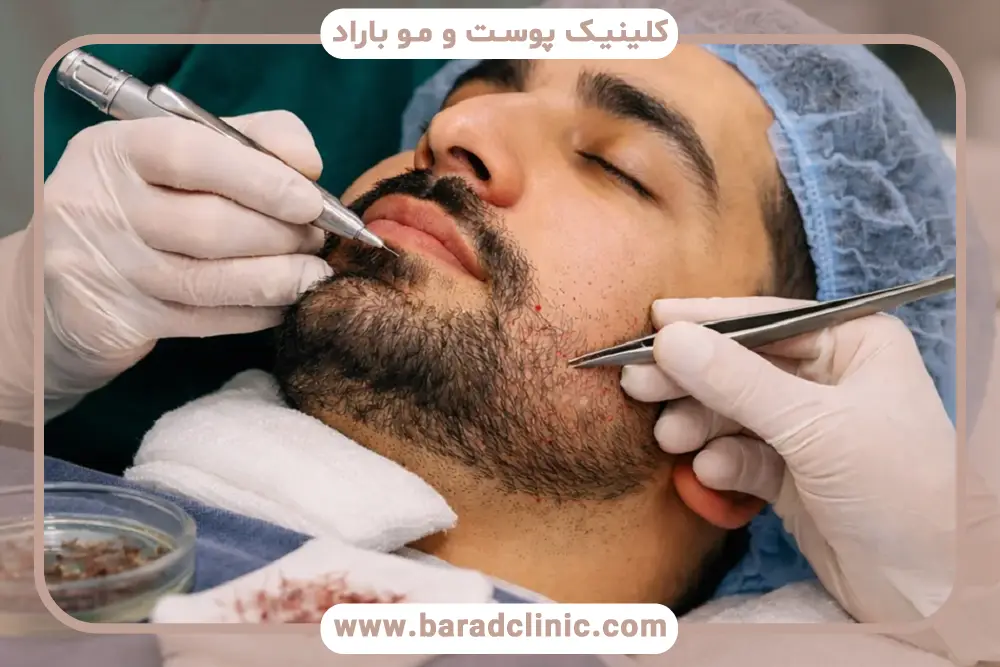 کاشت ریش درد دارد؟ راهکارهای کاهش درد