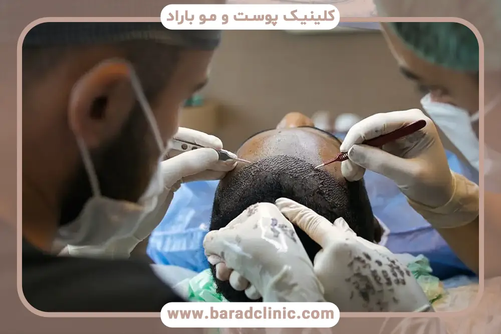 کاشت مو با نیدل بهتر است یا FUE؟ مقایسه دوره نقاهت