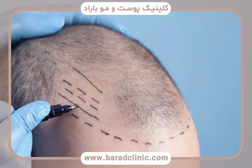 تفاوت هزینه کاشت مو شقیقه در آقایان و بانوان