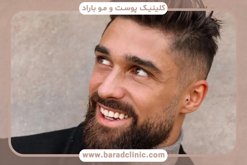 تاثیر مراقبتها در رشد ریش بعد از کاشت