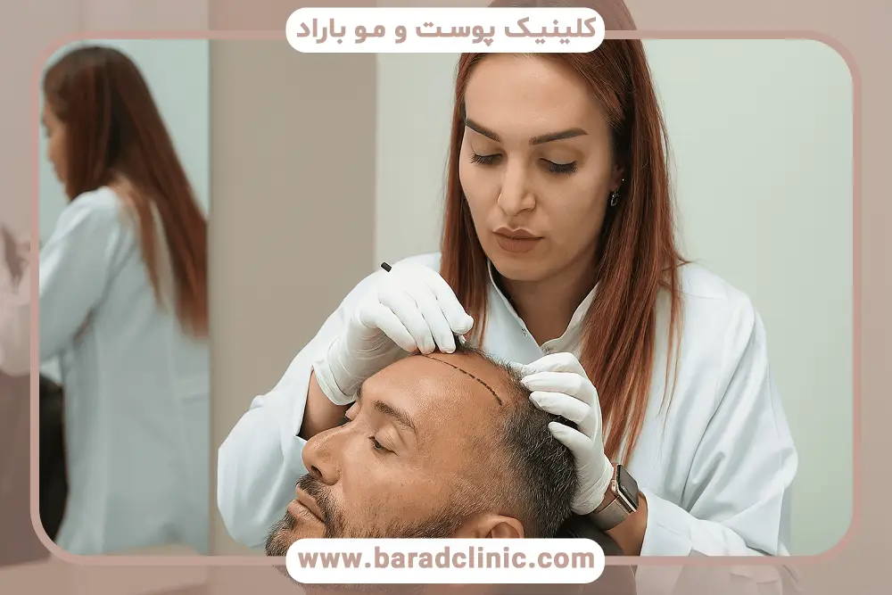 پرداخت هزینه کاشت مو میکروگرافت با بیمه