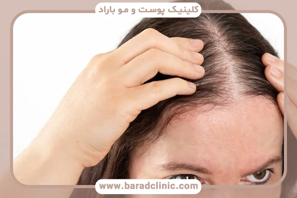 بررسی کبد چرب و ریزش مو و نقش انسولین