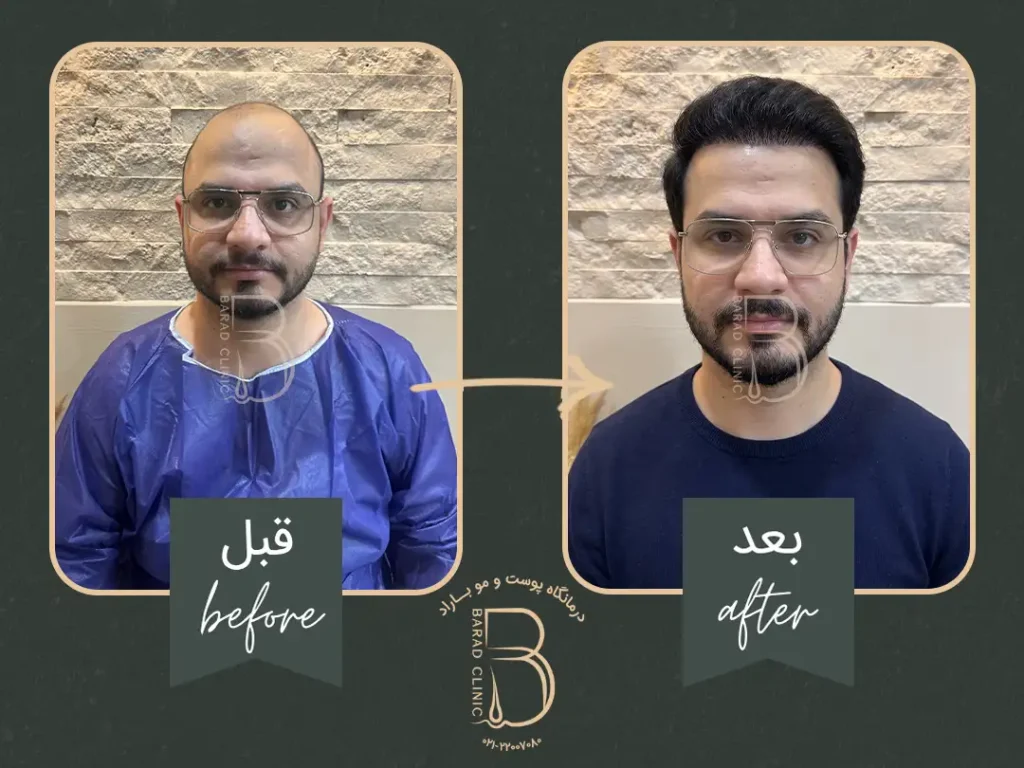 کاشت مو بعد از یکسال در کلینیک باراد