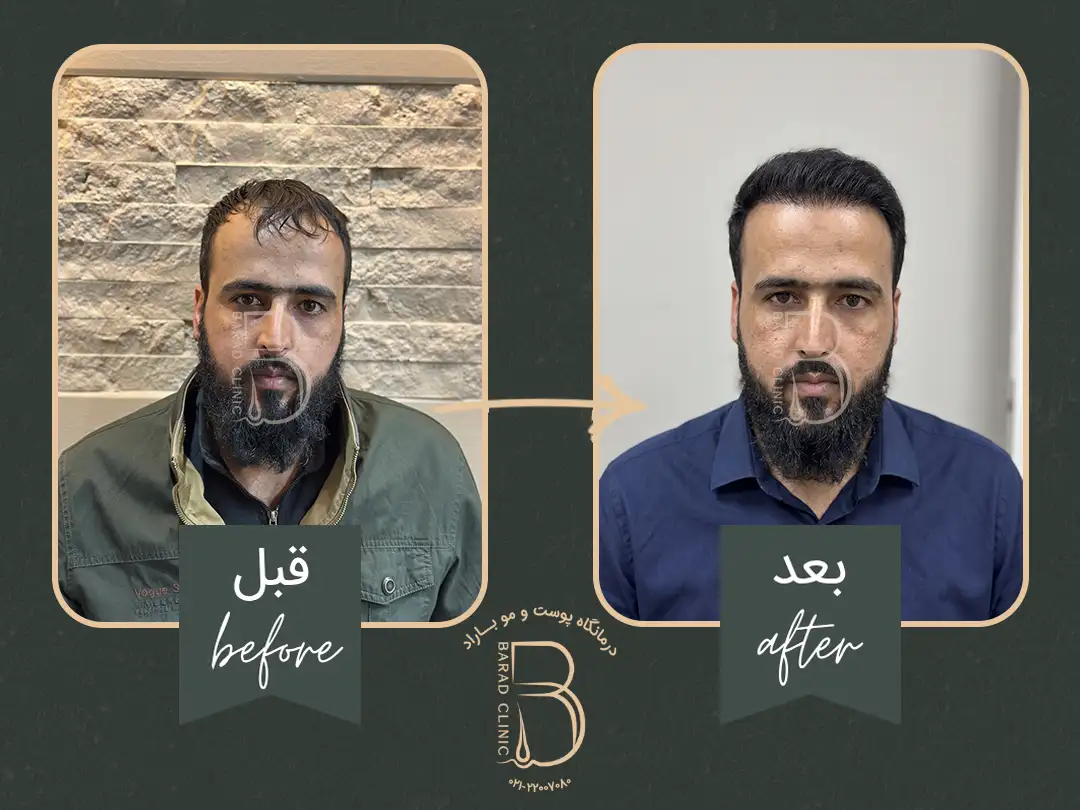 جراحی کاشت مو بعد از یکسال