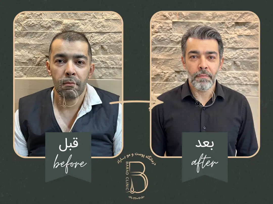 نمونه کار نتیجه نهایی کاشت در کلینیک باراد
