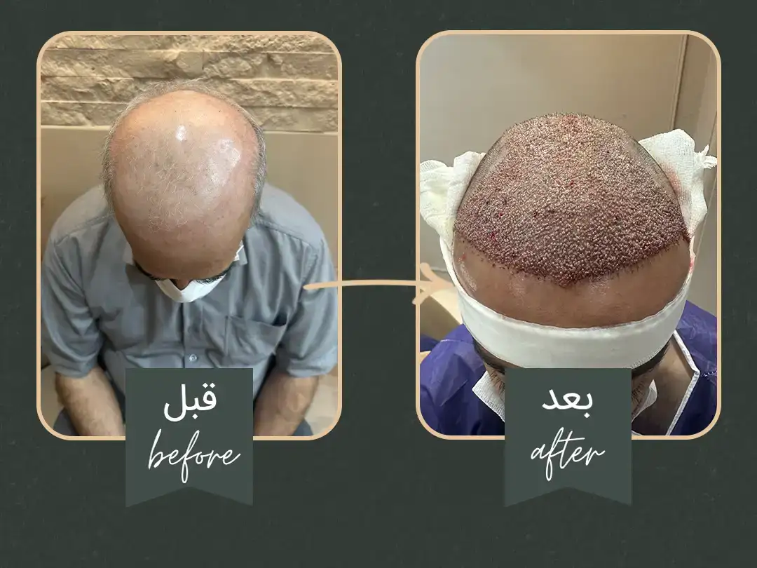 کاشت مو و طراحی هیرلاین حرفه ای در کلینیک باراد
