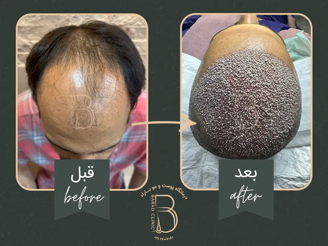 کاشت مو به روش سوپر sut درکلینیک باراد