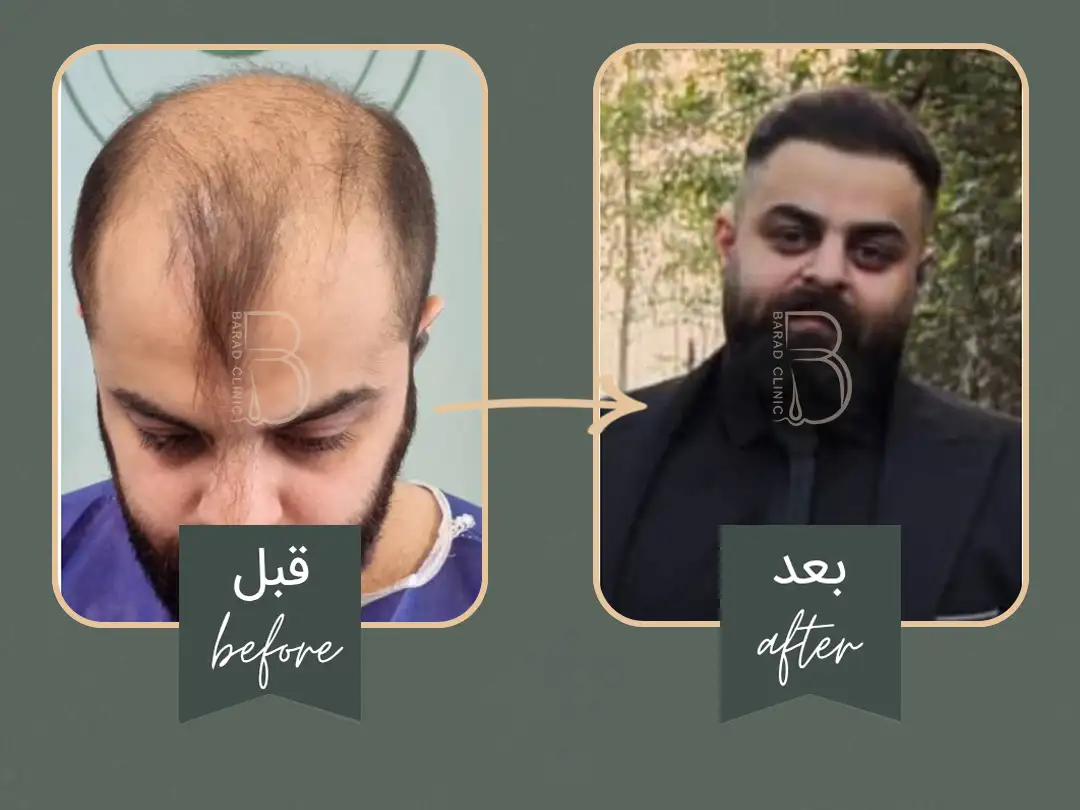 نمونه کار کاشت مو باراد