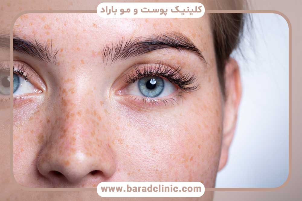 کاشت ابرو چقدر طول می‌کشد؟