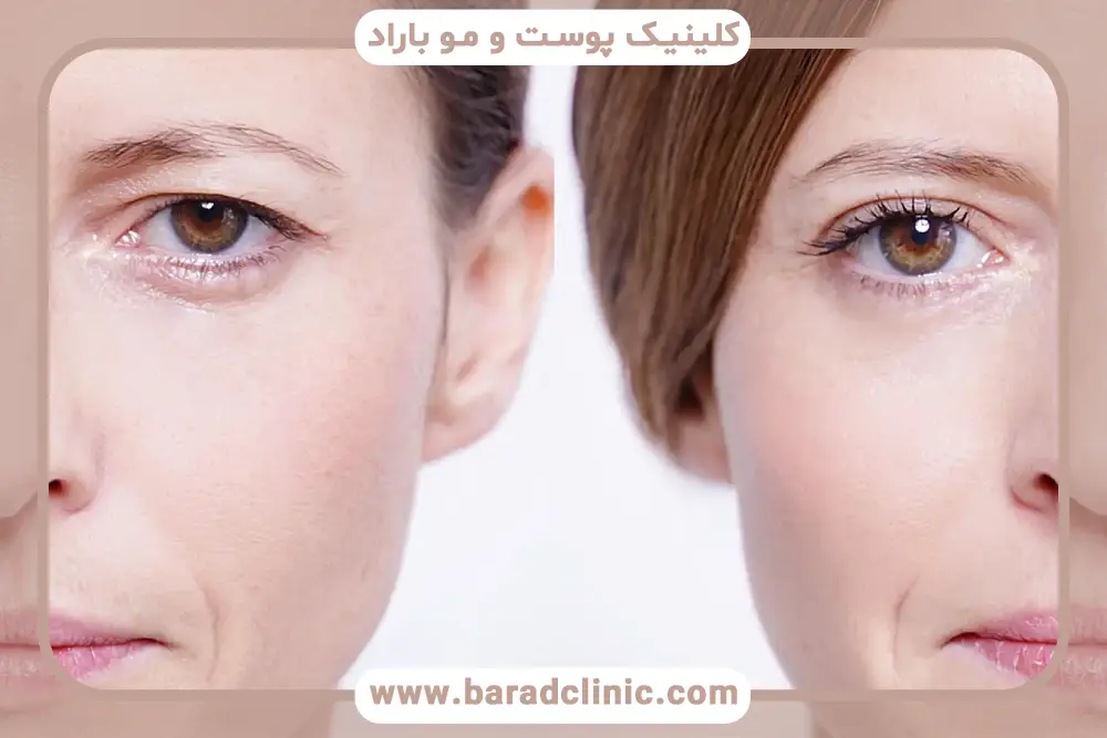 علت افتادگی پلک