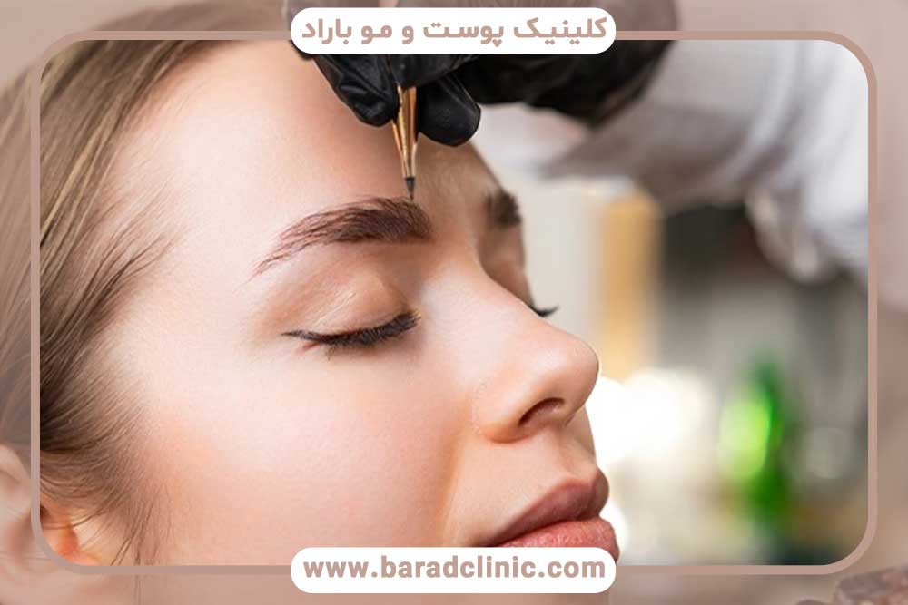 کاشت ابرو یا پیوند مو ابرو