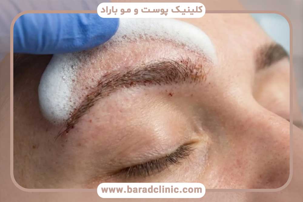 آبپاشی ابرو بعد از کاشت ابرو