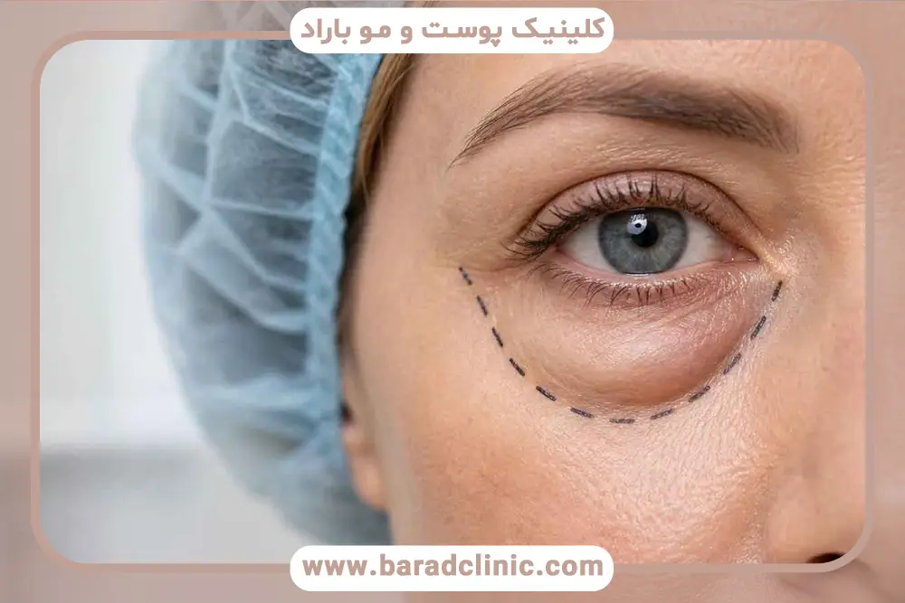 افتادگی پلک یک چشم