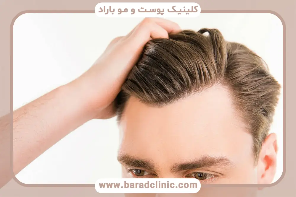 هزینه کاشت مو با تراکم بالا
