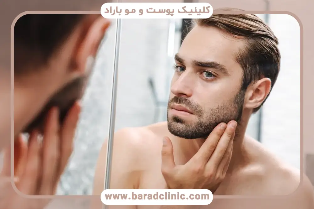 شستشو بعد از کاشت ریش