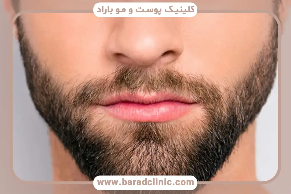 جای زخم کاشت ریش