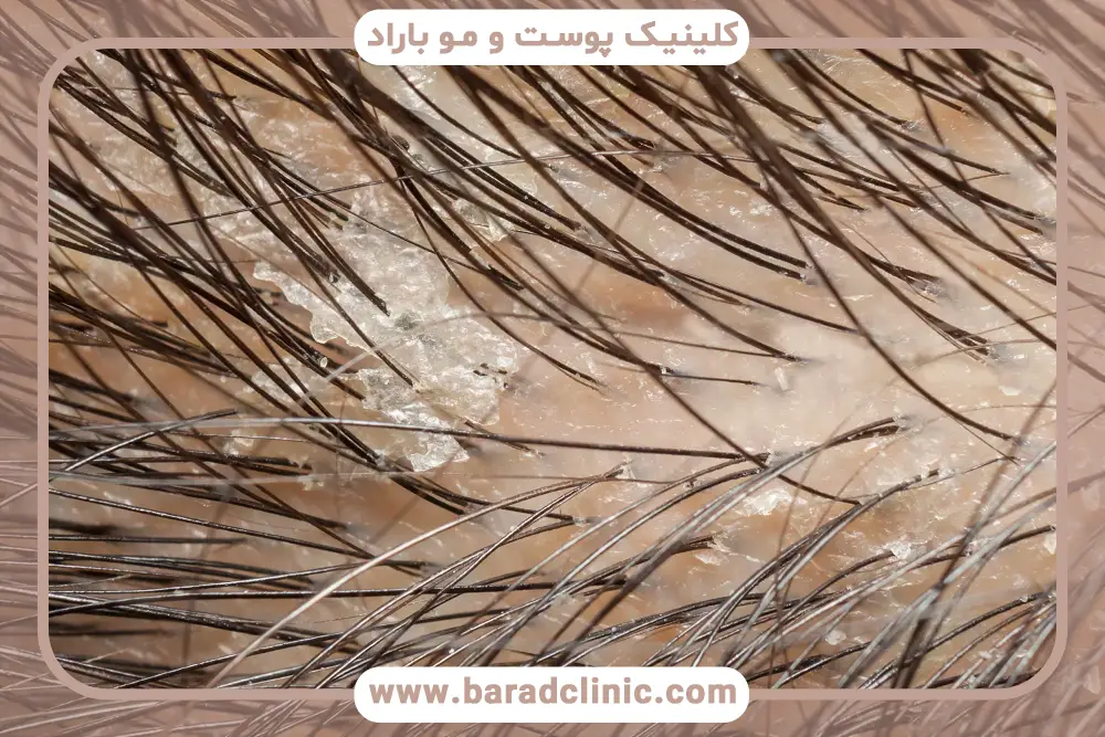 ریزش ریش همراه با پوسته