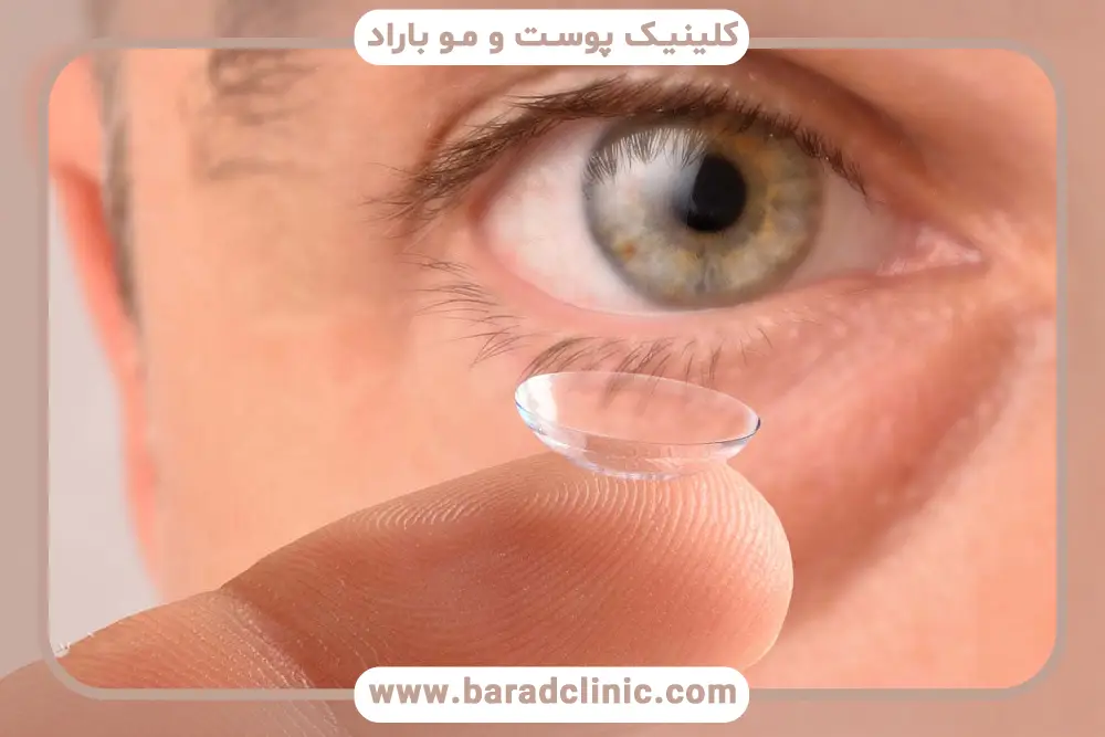 لنز بعد از جراحی بلفاروپلاستی