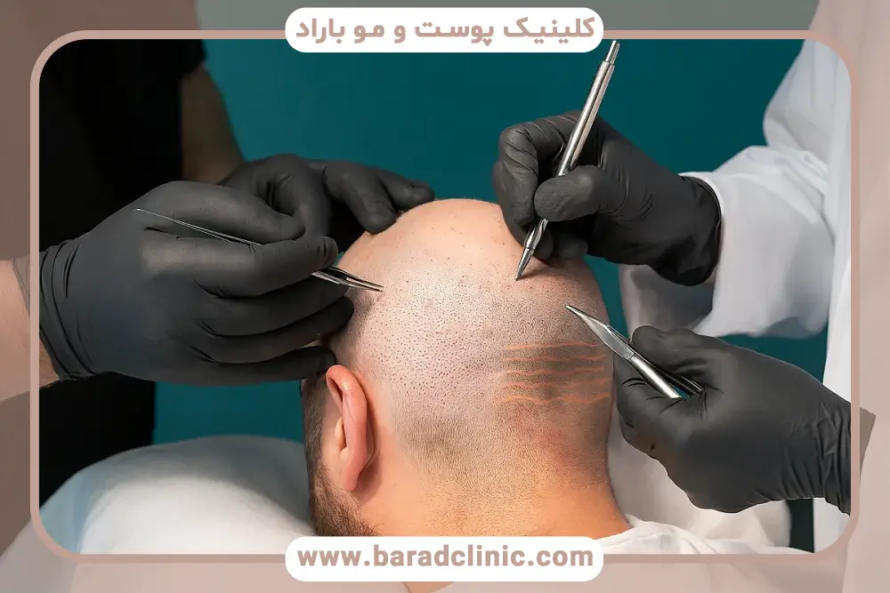 جدیدترین روش کاشت مو بدون درد