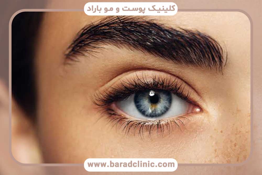 تعداد فولیکول‌های لازم برای کاشت ابرو
