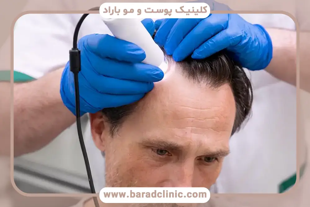کاشت مو به روش تکثیر پیاز مو