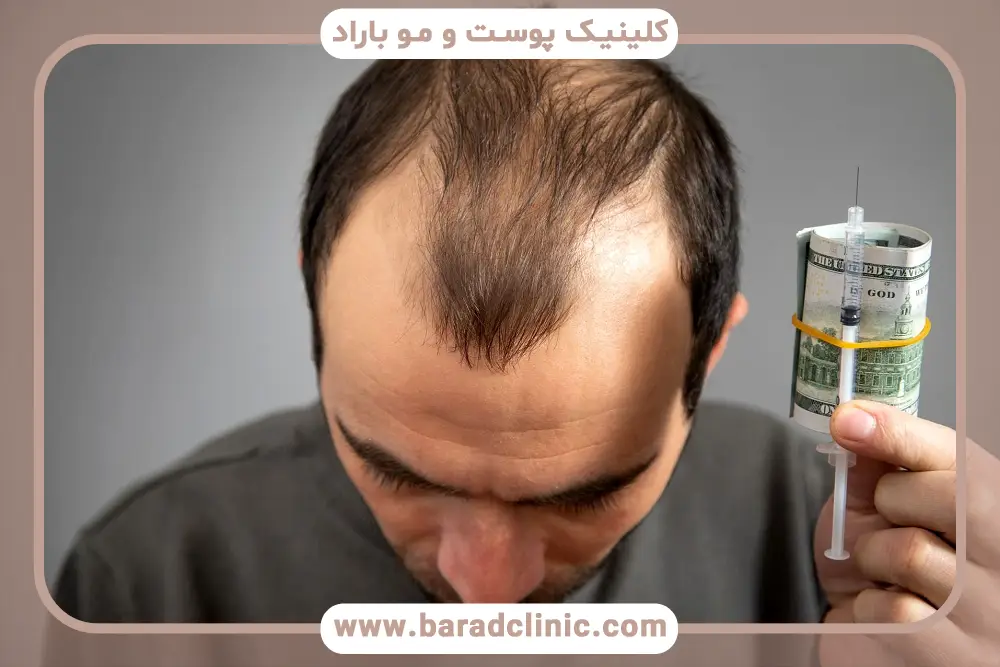 تفاوت کاشت مو به روش sut و fue