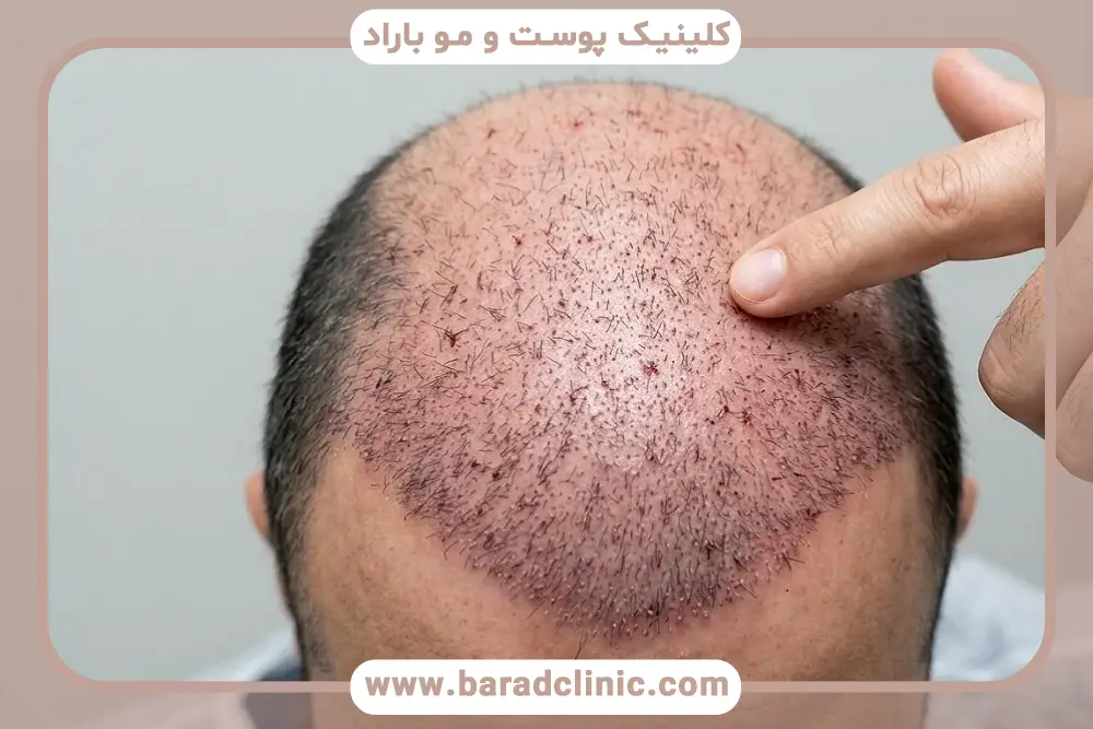پی ار پی موی سر بعد از کاشت مو