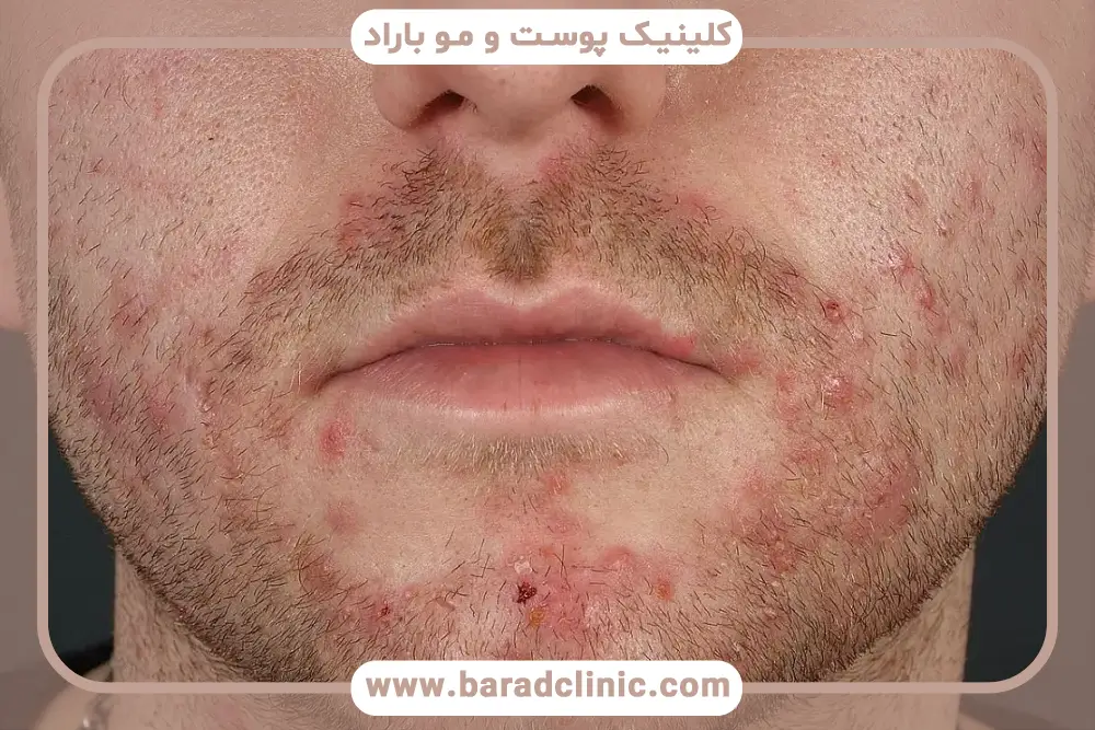 فولیکولیت ریش
