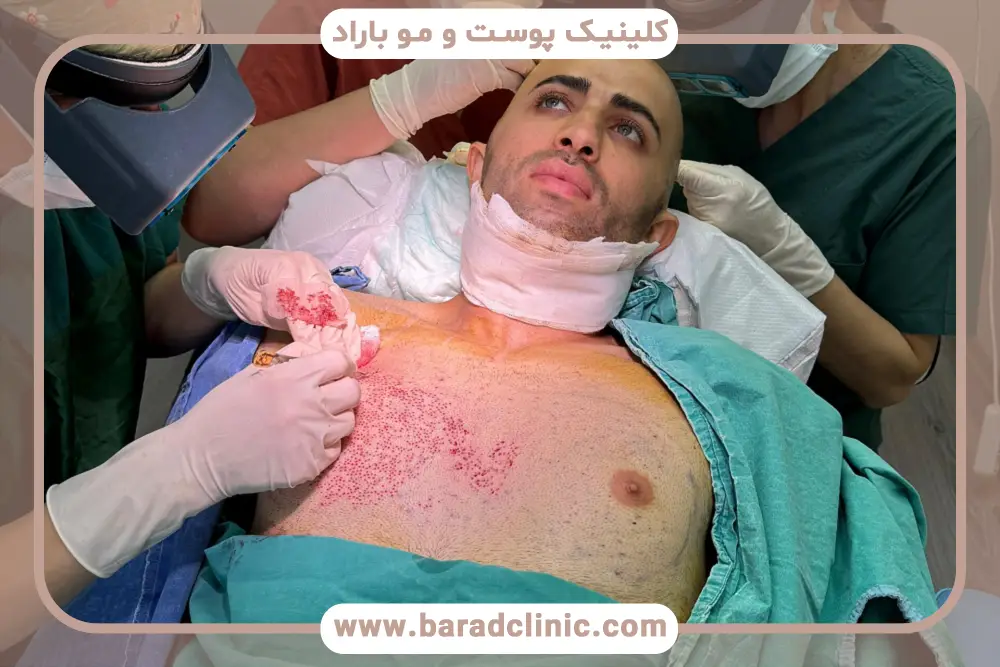 کاشت مو به روش hrt