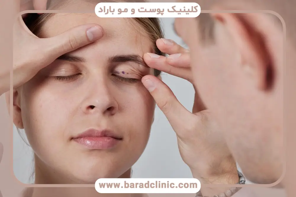افتادگی پلک چیست؟