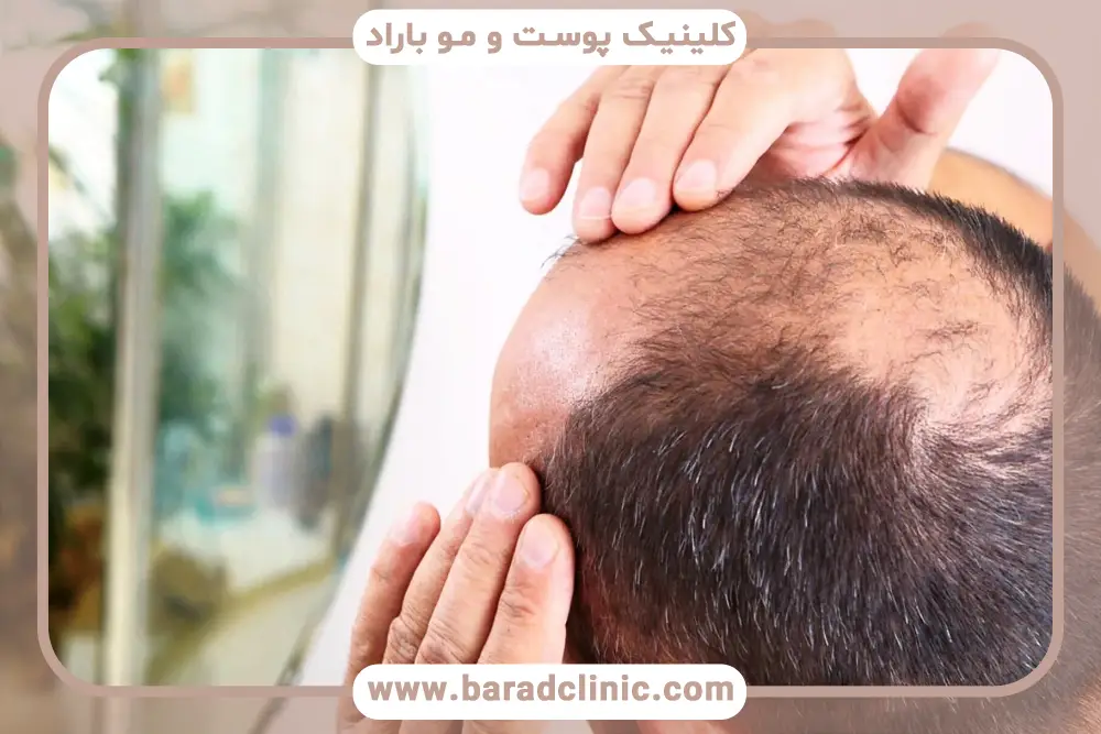 جلوگیری از ریزش مو در مردان