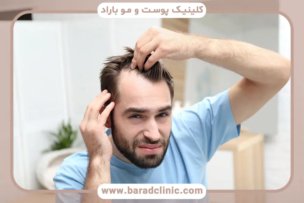 علت طاسی مردان