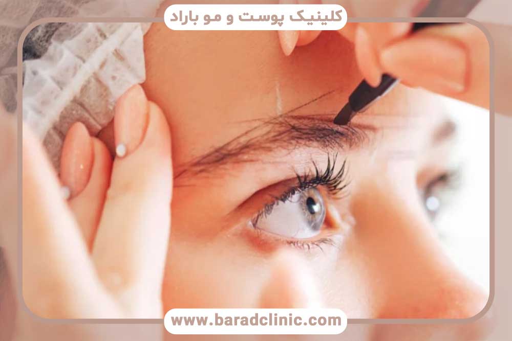 بهترین سن برای کاشت ابرو