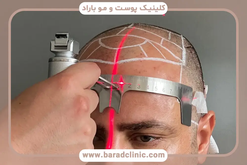 کاشت مو با دستگاه بهتر است یا با دست؟